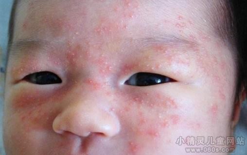 什么是季节性湿疹 宝宝季节性湿疹的症状