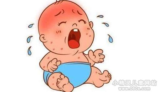 婴儿湿疹的症状 婴儿湿疹怎么办